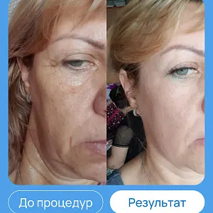 ЭХВЧ МТУСИ-50 обновленный