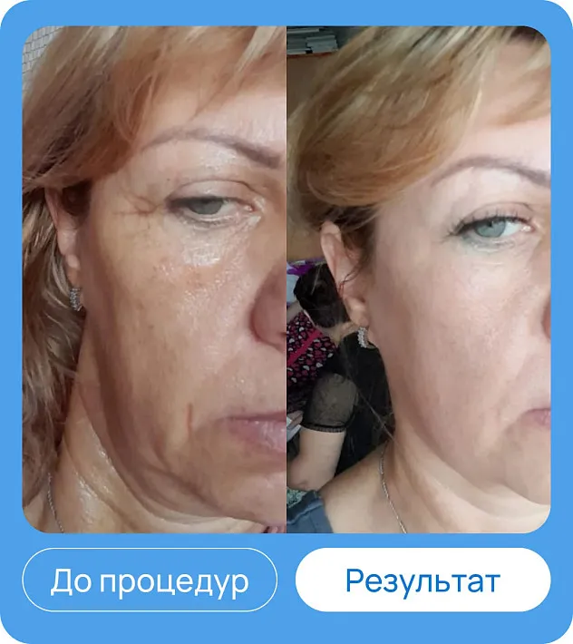 ЭХВЧ МТУСИ-50 обновленный