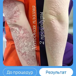 ЭХВЧ МТУСИ-50 обновленный