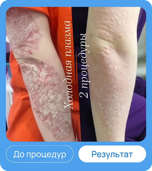 ЭХВЧ МТУСИ-50 обновленный