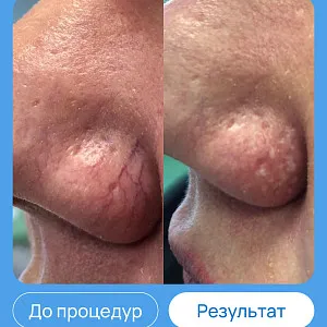 ЭХВЧ МТУСИ-50 обновленный
