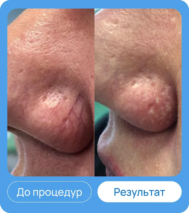 ЭХВЧ МТУСИ-50 обновленный