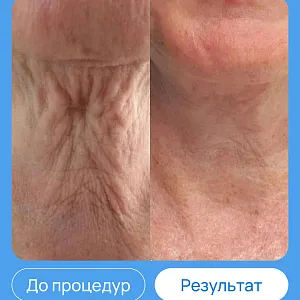 ЭХВЧ МТУСИ-50 обновленный