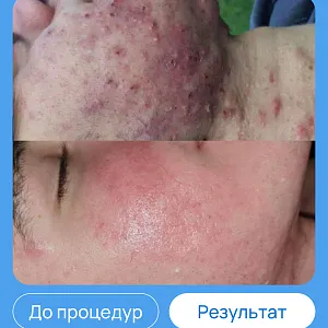 ЭХВЧ МТУСИ-50 обновленный