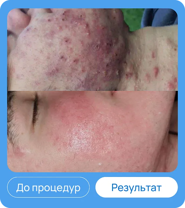 ЭХВЧ МТУСИ-50 обновленный