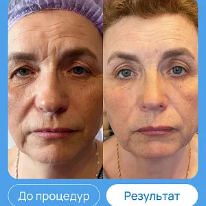 ЭХВЧ МТУСИ-50 обновленный
