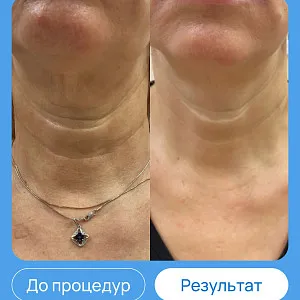 ЭХВЧ МТУСИ-50 обновленный