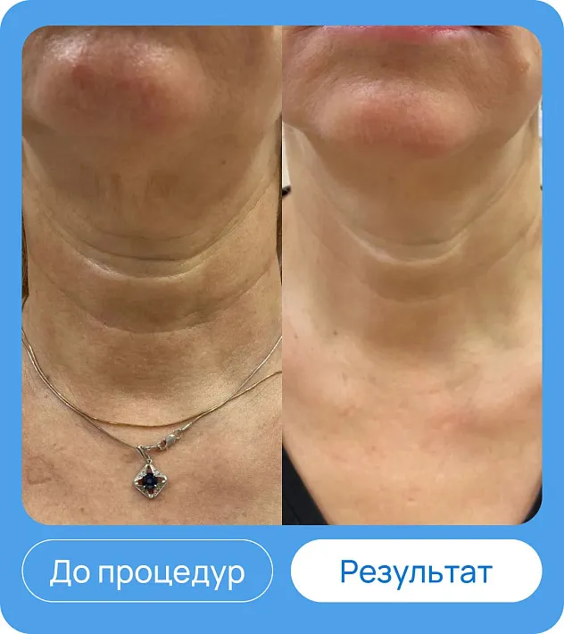 ЭХВЧ МТУСИ-50 обновленный