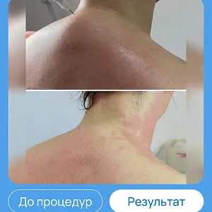 ЭХВЧ МТУСИ-50 обновленный