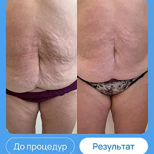ЭХВЧ МТУСИ-50 обновленный