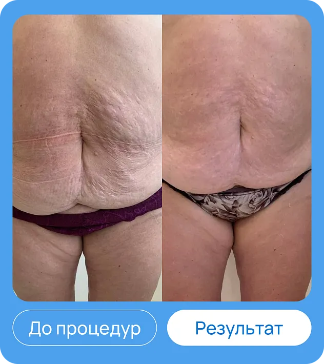 ЭХВЧ МТУСИ-50 обновленный