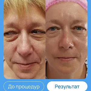 ЭХВЧ МТУСИ-50 обновленный