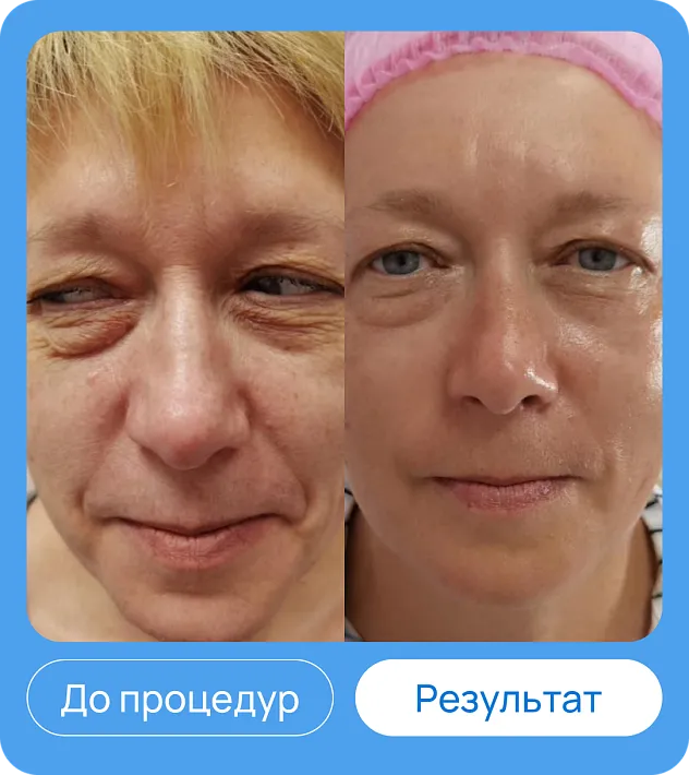 ЭХВЧ МТУСИ-50 обновленный