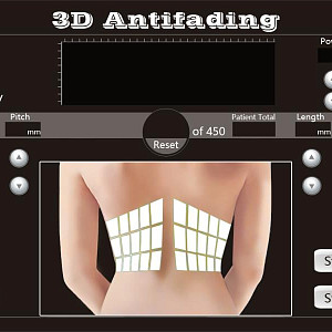 4D HIFU