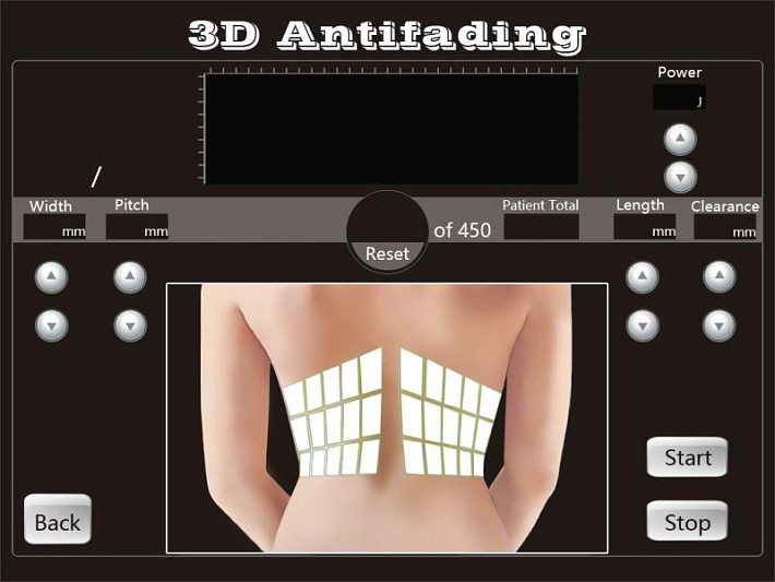 4D HIFU