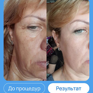 ЭХВЧ МТУСИ-50 обновленный