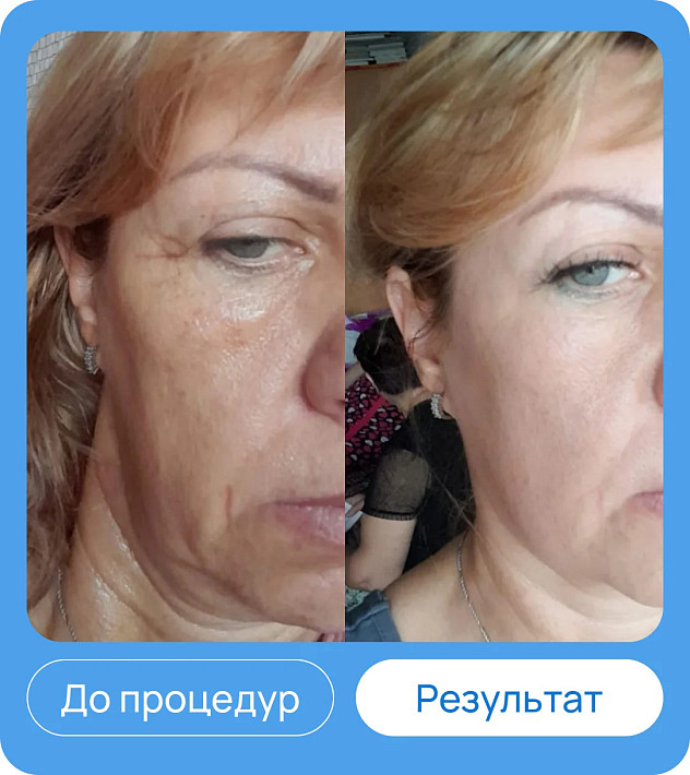 ЭХВЧ МТУСИ-50 обновленный