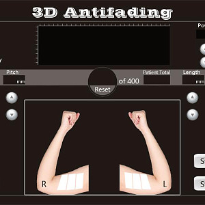 4D HIFU
