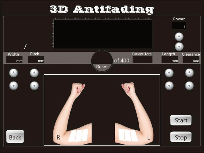 4D HIFU