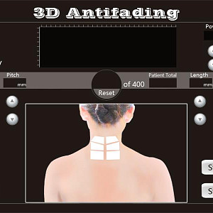 4D HIFU