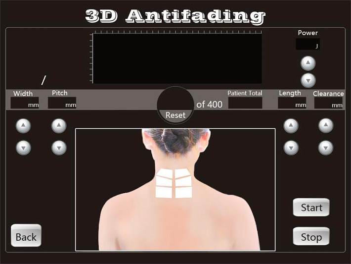 4D HIFU