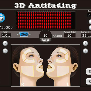 4D HIFU