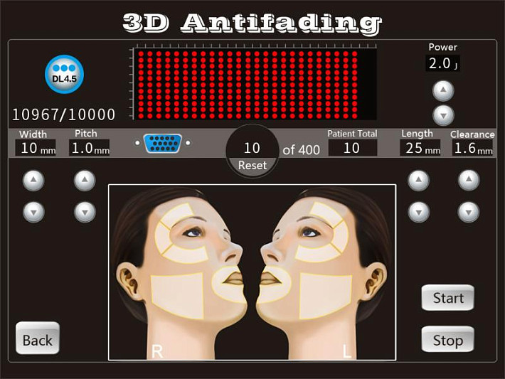 4D HIFU