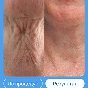 ЭХВЧ МТУСИ-50 обновленный
