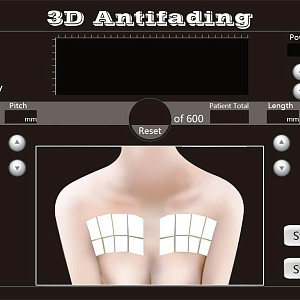 4D HIFU