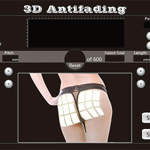 4D HIFU