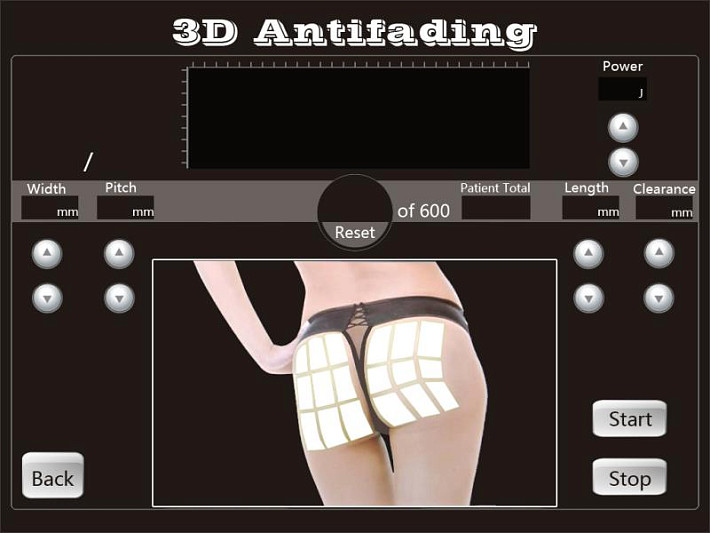 4D HIFU