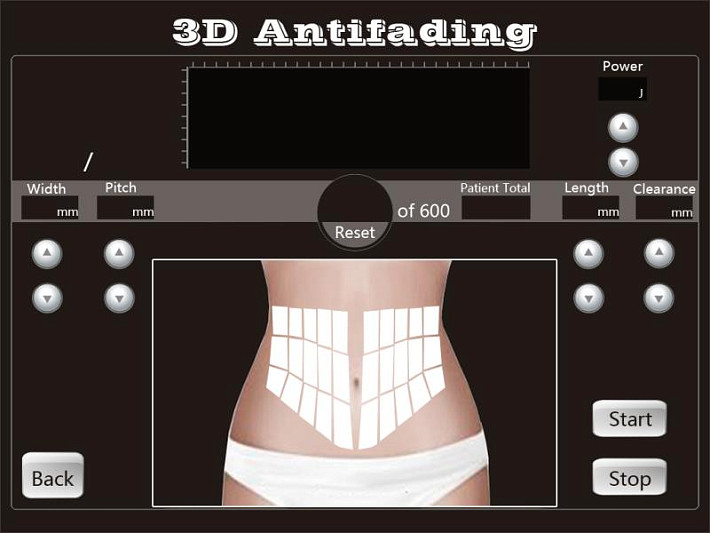 4D HIFU