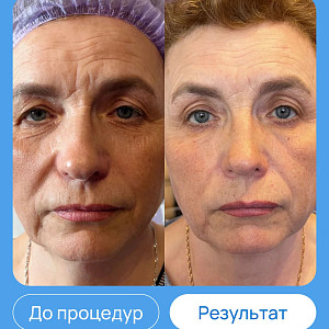ЭХВЧ МТУСИ-50 обновленный