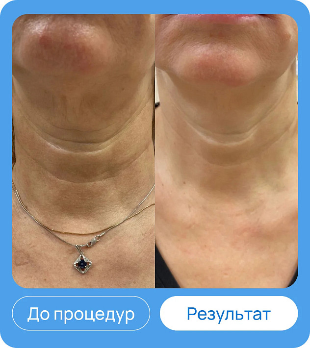 ЭХВЧ МТУСИ-50 обновленный