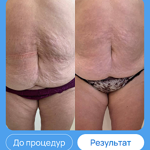 ЭХВЧ МТУСИ-50 обновленный