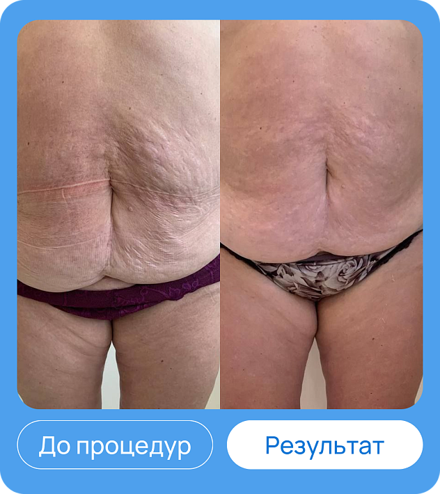 ЭХВЧ МТУСИ-50 обновленный
