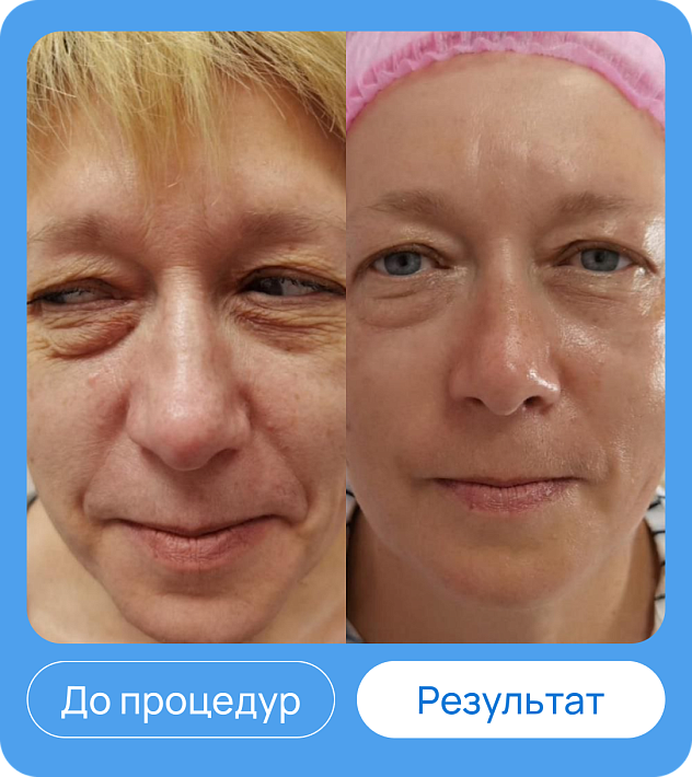 ЭХВЧ МТУСИ-50 обновленный